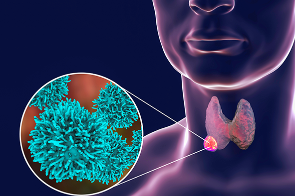 ret-mutated thyroid cancer
